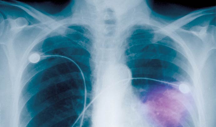 Chest X-ray of pneumonia in a 72-year-old woman